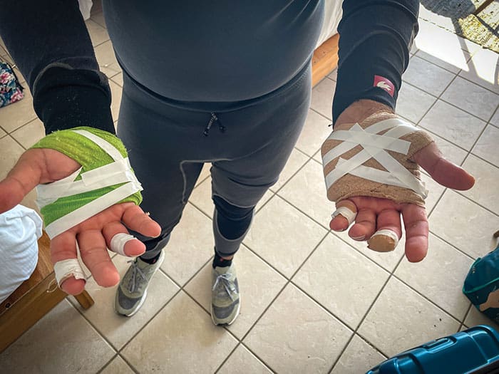 A Worrell 1000 sailor revealing chafe injuries to his hands. In major sailing races, it’s common for participants to suffer cracked, cut and blistered hands due to heavy loads on the lines and salt water. Photo Courtesy of Worrell 1000 Race, Inc. 