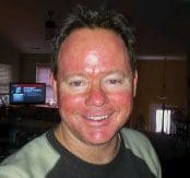 No stranger to sun damage, Outer Banks Coastal Life’s editor, Jeff Donohue, underwent photodynamic therapy – better known as “blue light treatment” a few years back. While closely resembling a mean sunburn, the procedure helps to eliminate pre-cancer cells, with the red glow typically subsiding in less than a week.